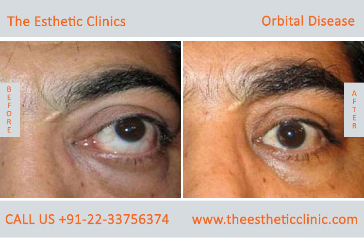 Thyroid Eye Disease treatment, Graves Eye Disease Surgery before after photos india ( (3)